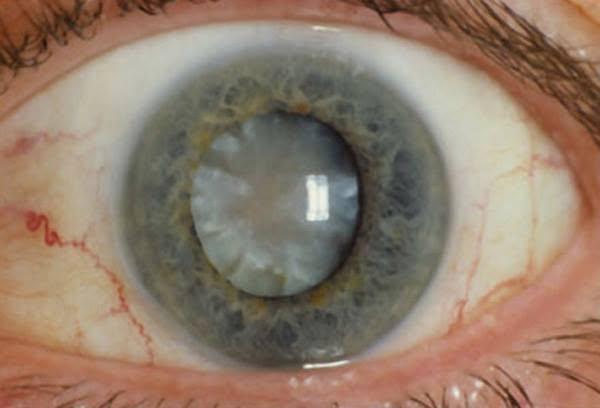 Cataract Surgery Cost Wait Risks 2026